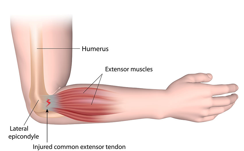 Avoid Tennis Elbow Tennisnerd Arm friendly Strings and